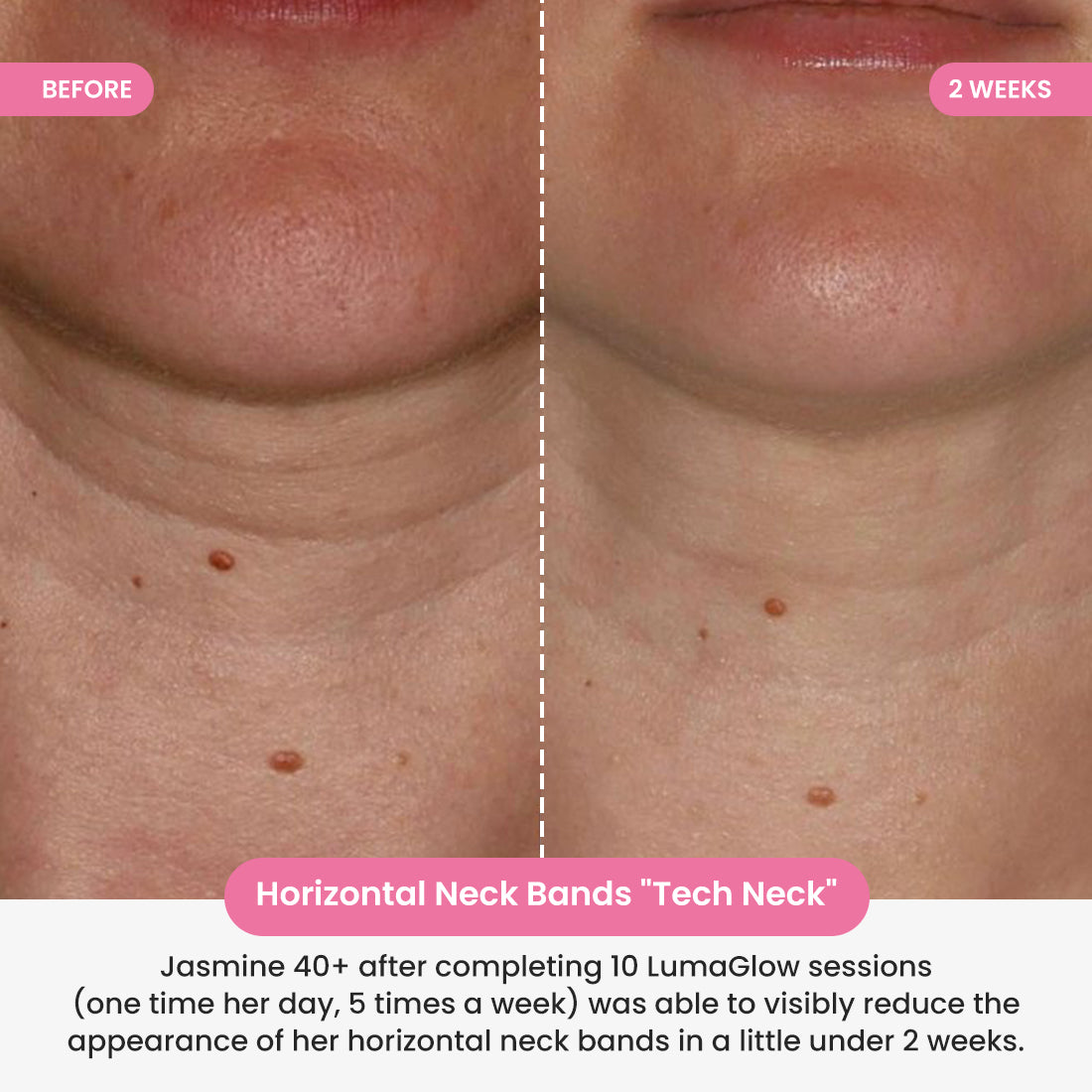 LumaGlow 7-in-1 LED Neck Lifter