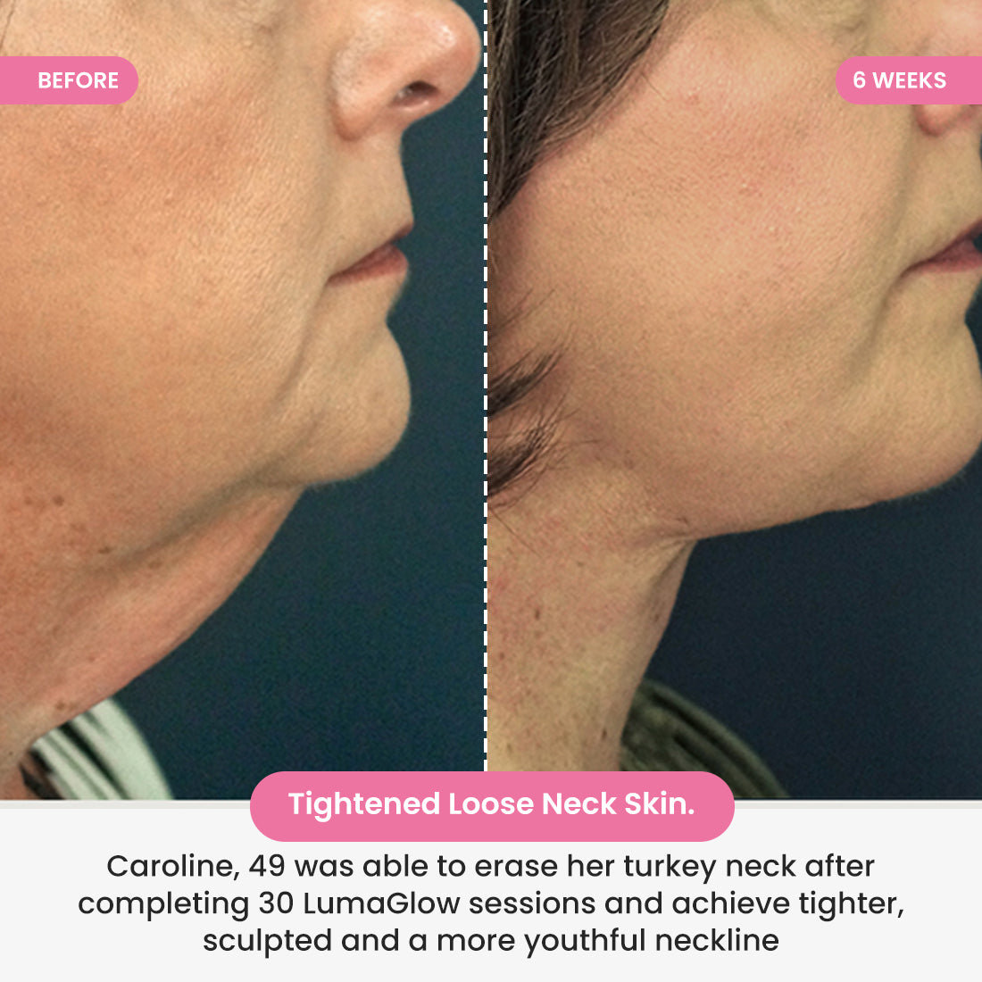 LumaGlow 7-in-1 LED Neck Lifter